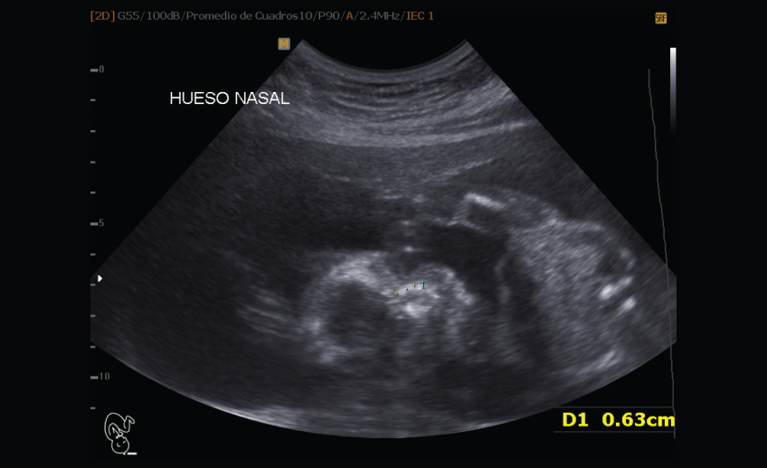 Ultrasonido Estructural