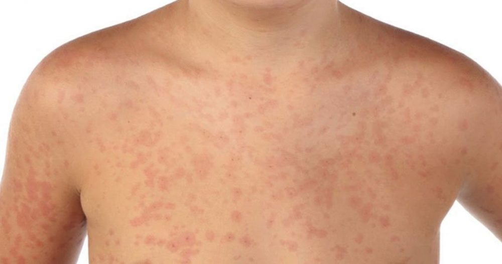 casos de sarampion en mexico