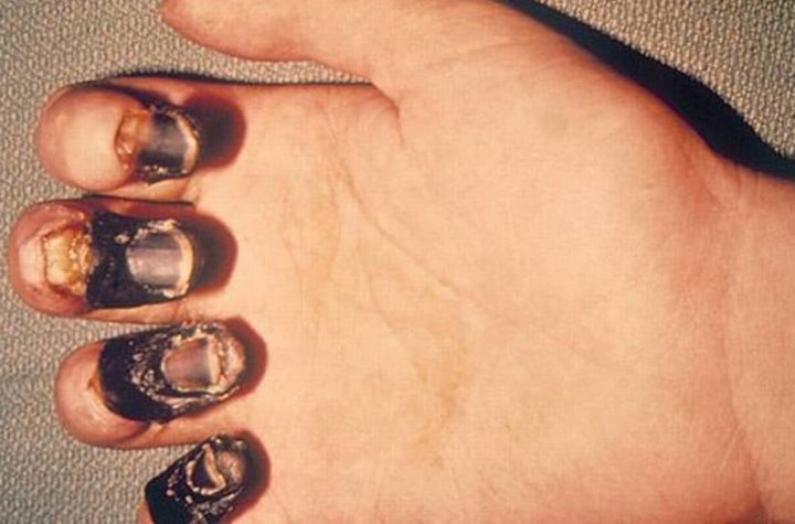 ¿Que es el peste bubónica o peste negra?