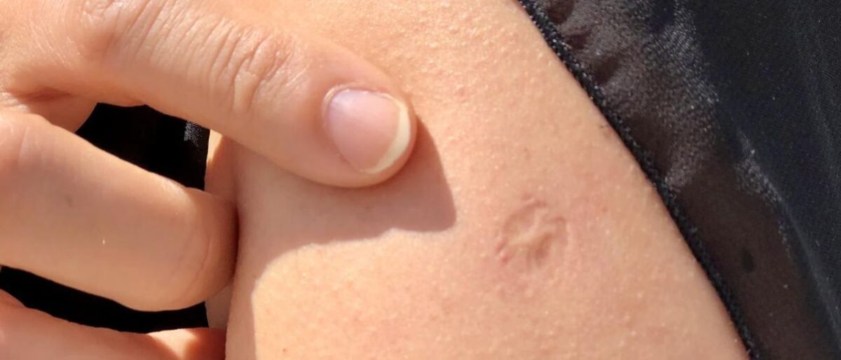 Cicatriz Vacuna Viruela